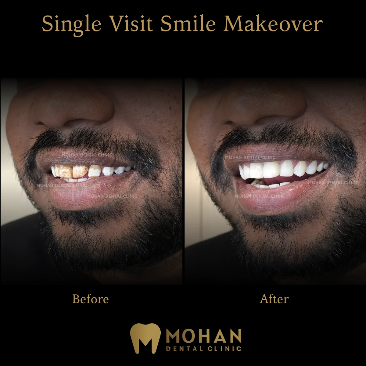 Single Visit Fluorosis Treatment, Before and After at Mohan Dental Clinic