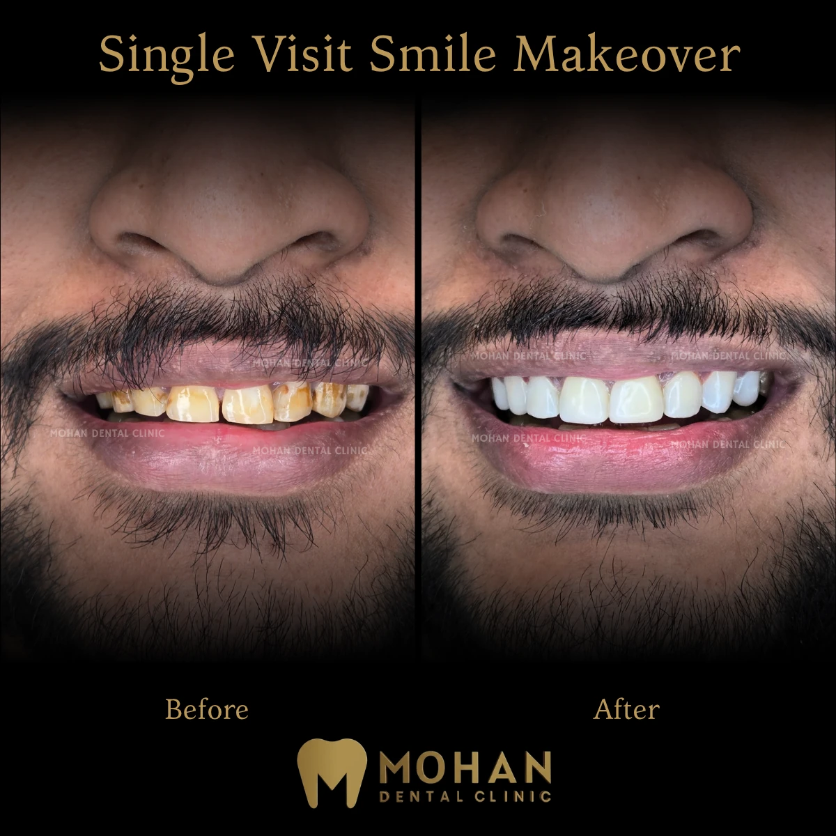 Heavy Stains Removed, Before and After at Mohan Dental Clinic