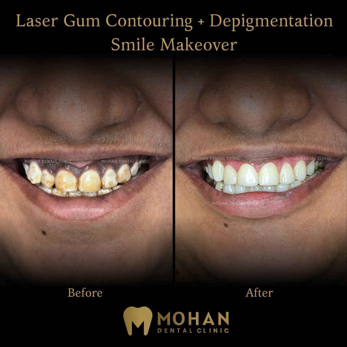 Gum Contouring + Makeover, Before and After at Mohan Dental Clinic