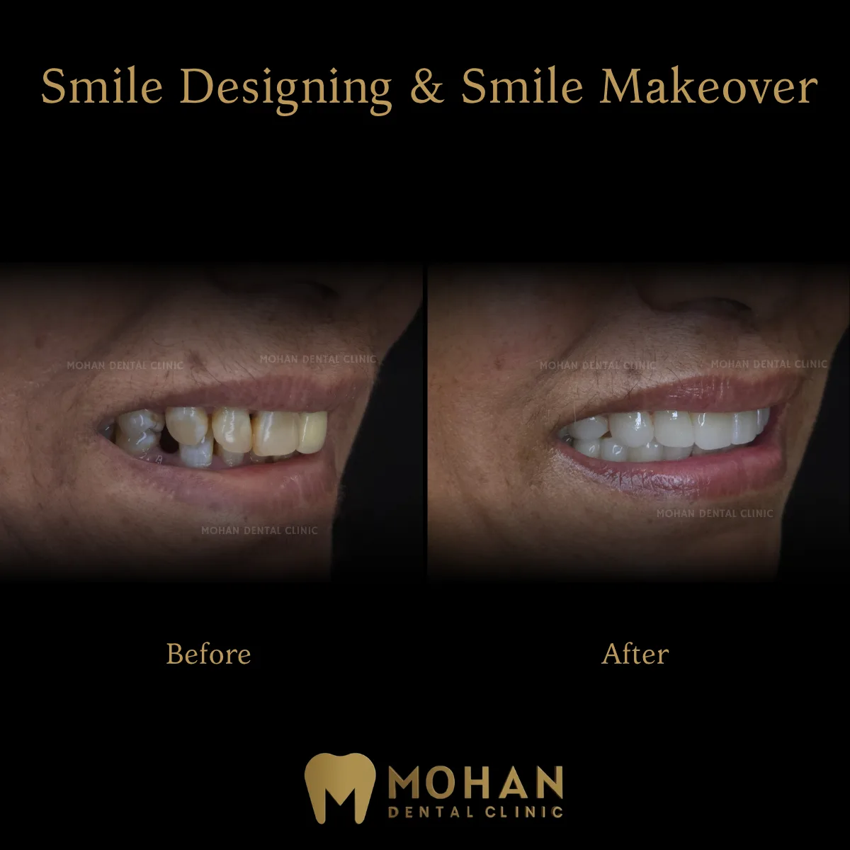 Smile Designing, Before and After at Mohan Dental Clinic