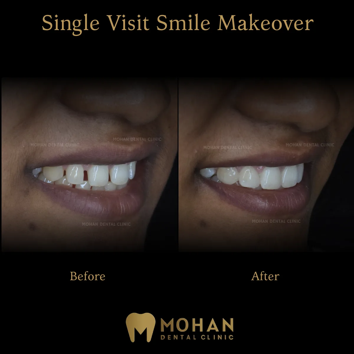 Gap Closure, Before and After at Mohan Dental Clinic