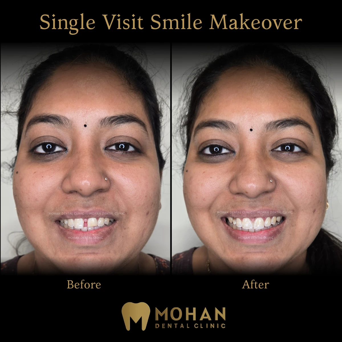 Single Visit Space Closure, Before and After at Mohan Dental Clinic