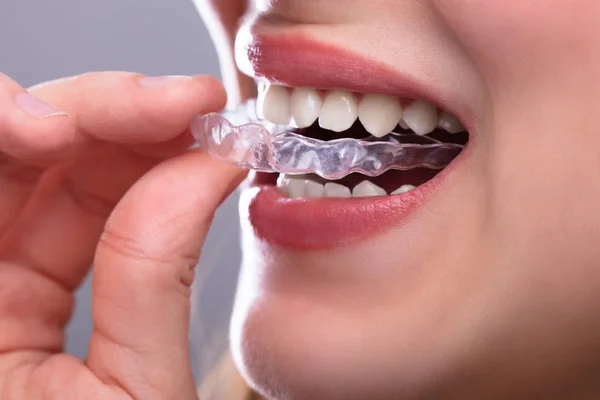 Aligners at Mohan Dental Clinic