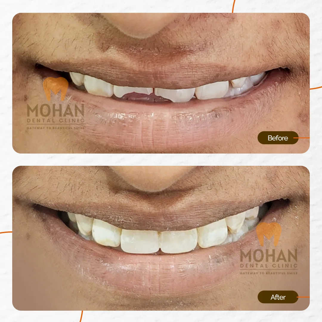 Cracked or Broken Teeth, Before & After at Mohan Dental Clinic