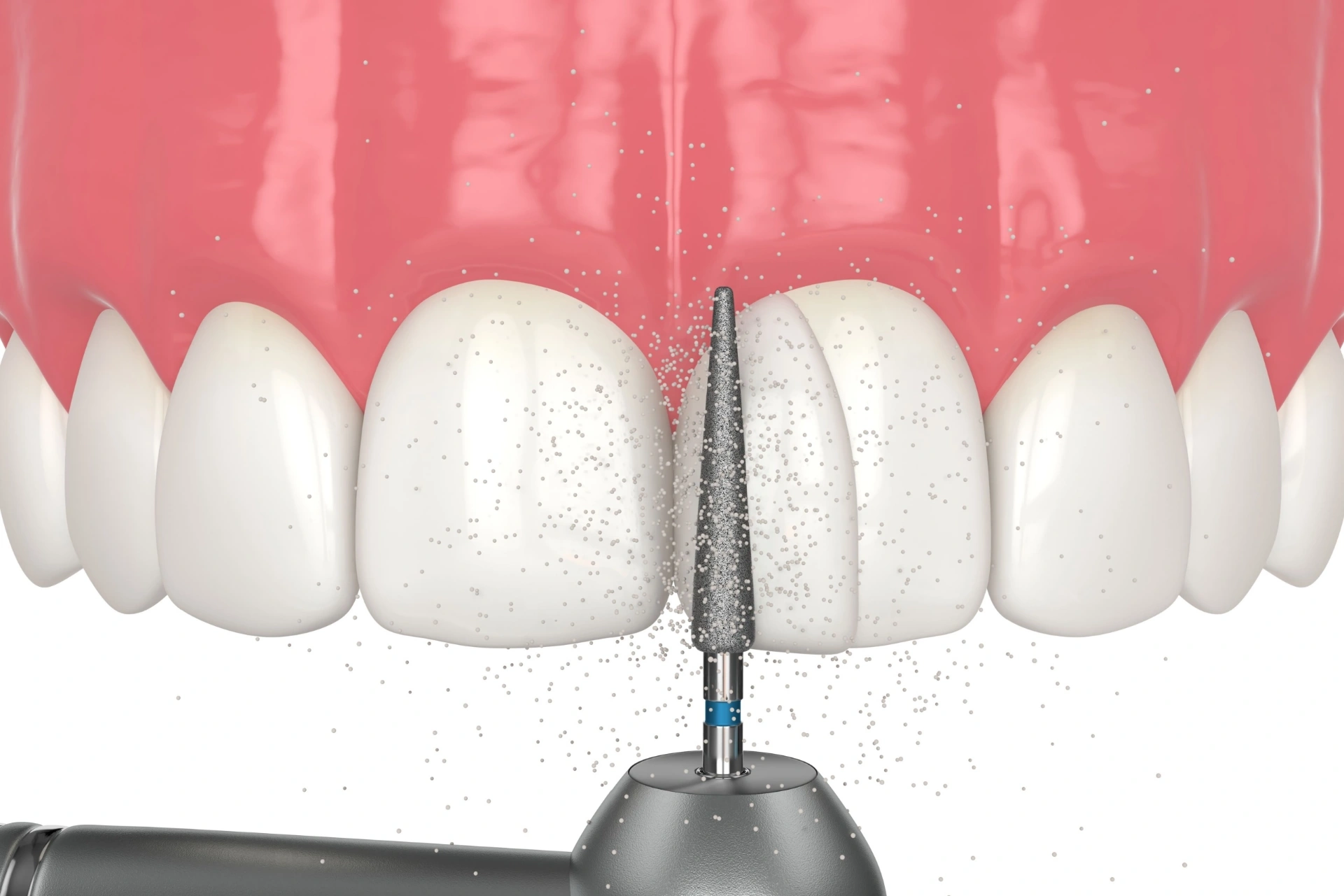 Composite Bonding at Mohan Dental Clinic