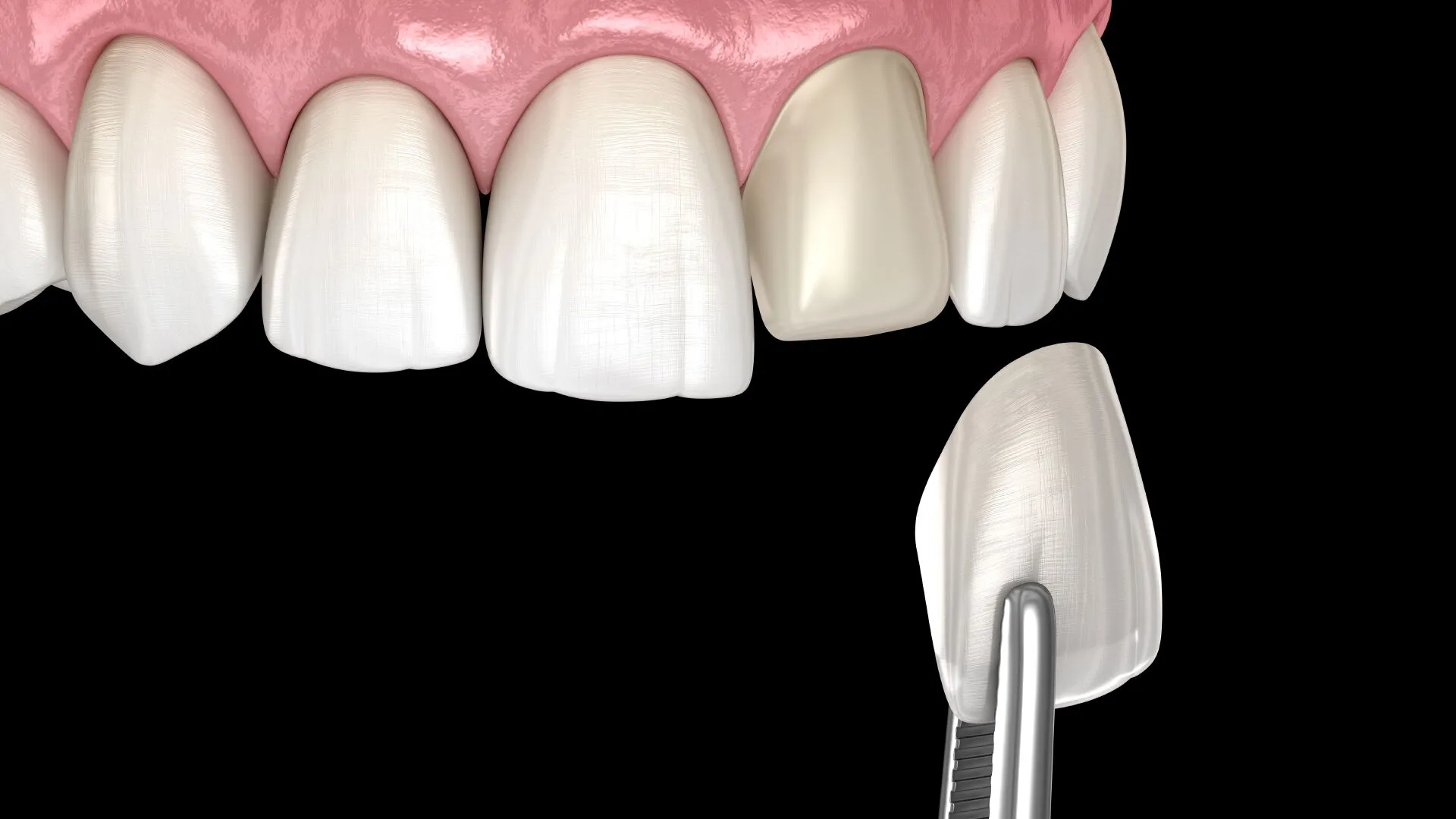 Composite Veneers at Mohan Dental Clinic