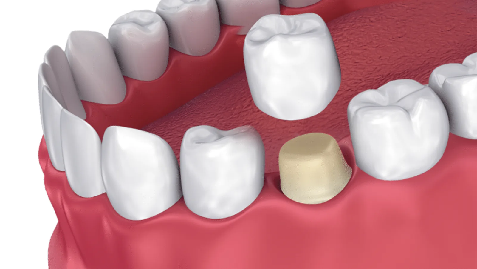 Dental Crowns at Mohan Dental Clinic