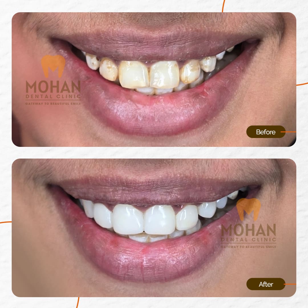 Discoloured / Yellow Teeth, Before & After at Mohan Dental Clinic