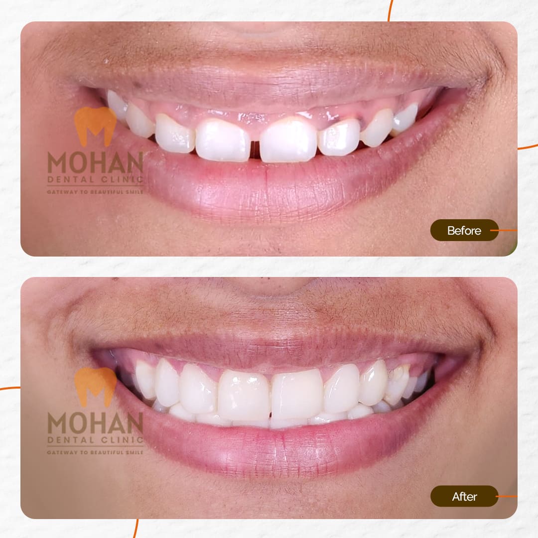 Gum Issues, Before & After at Mohan Dental Clinic