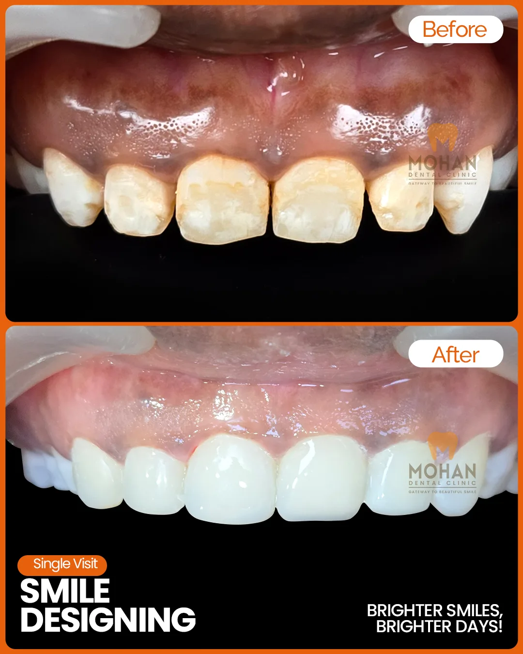 Gum Depigmentation at Mohan Dental Clinic