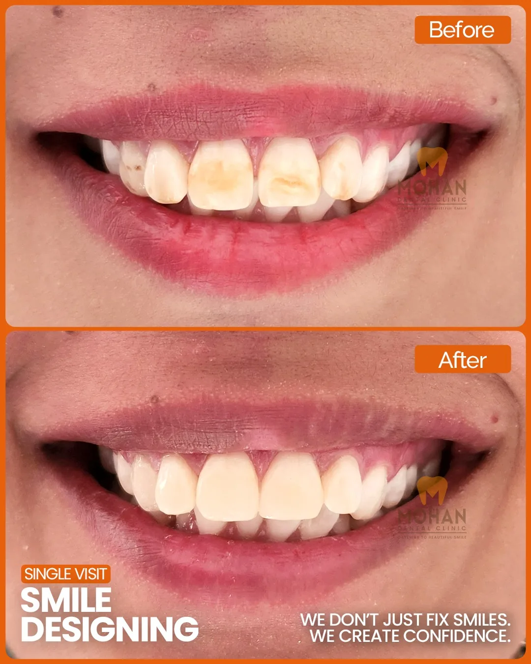Microabrasion at Mohan Dental Clinic