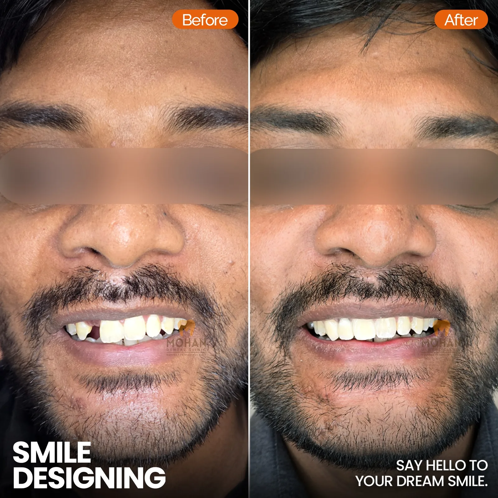 Missing Teeth, Before & After at Mohan Dental Clinic