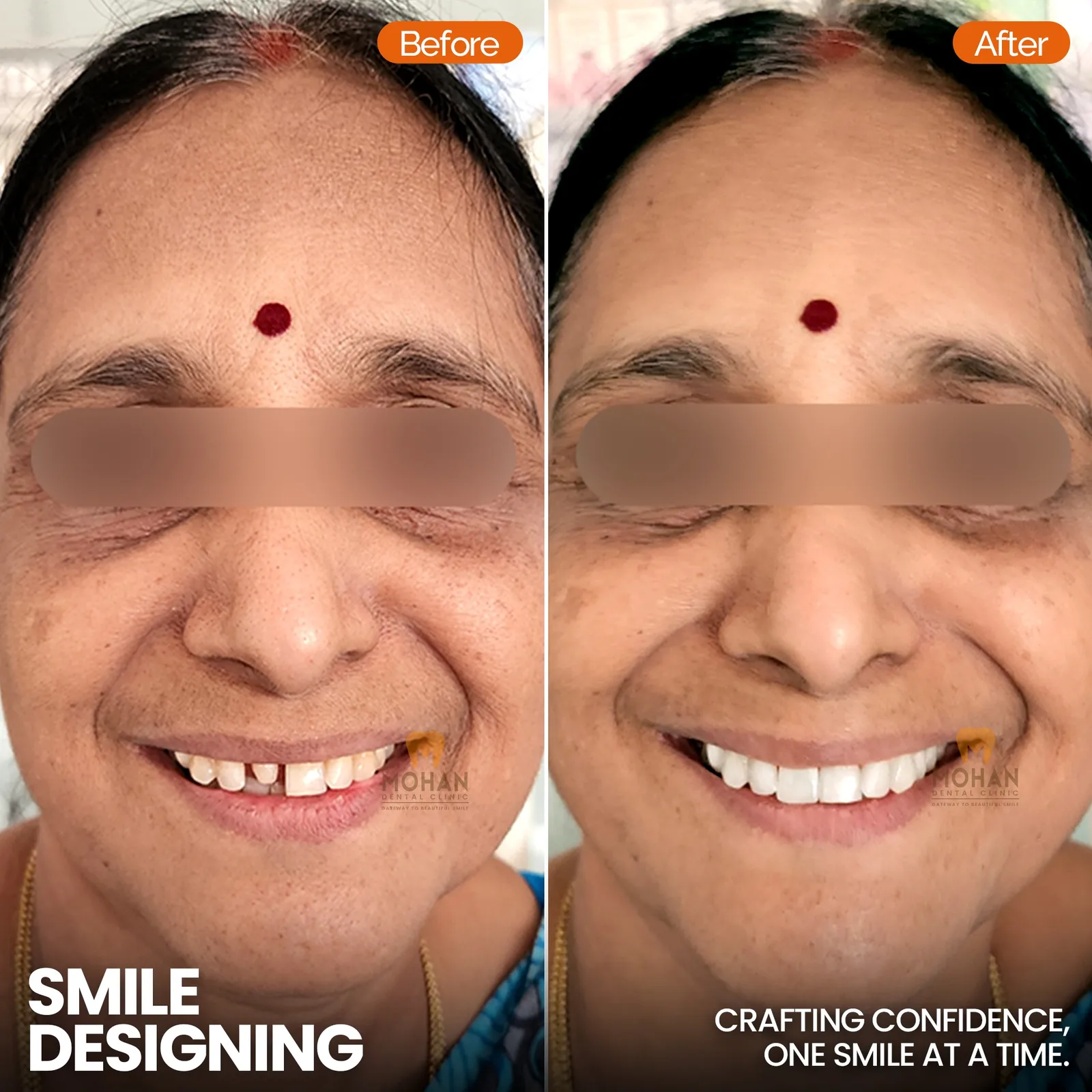 Smile Correction at Mohan Dental Clinic