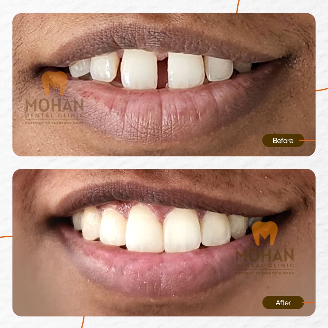 Gaps Between Teeth, Before & After at Mohan Dental Clinic